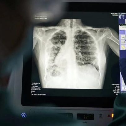 Europa perde 1 em 5 casos de TB por resistência a medicamentos