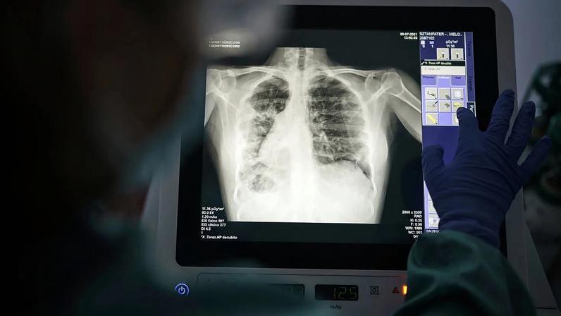 FILE - In this Friday, July 9, 2021 file photo, a health worker checks the x-ray in the Hospital del Mar in Barcelona, Spain.