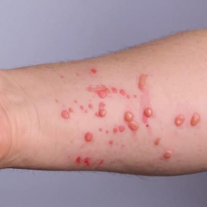 Nova cepa recombinante da Mpox preocupa OMS; antiviral mais usado não funciona