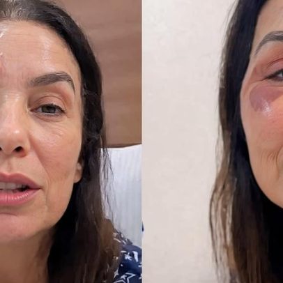 Nervo vago e síndrome vasovagal: esclarecimento sobre desmaios de Ivete Sangalo