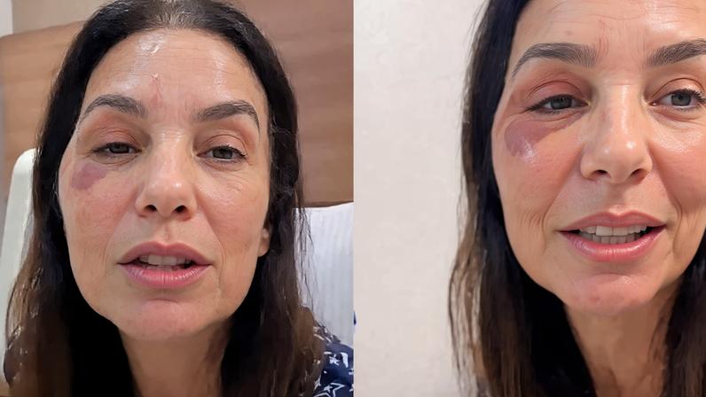 O que é o nervo vago? Neurologista explica relação com a síndrome vasovagal, diagnóstico de Ivete Sangalo que pode causar desmaios: ‘Corpo reage de forma exagerada’