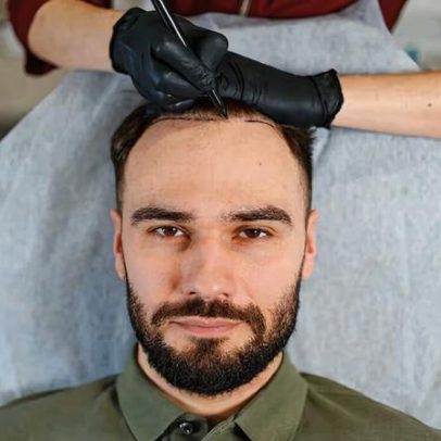 Transplante capilar: quando é necessário refazer o procedimento