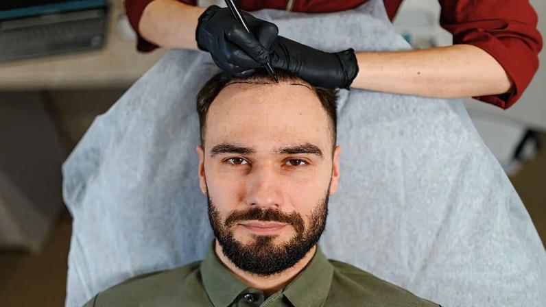 Transplante capilar: entenda quando pode ser necessário refazer o procedimento