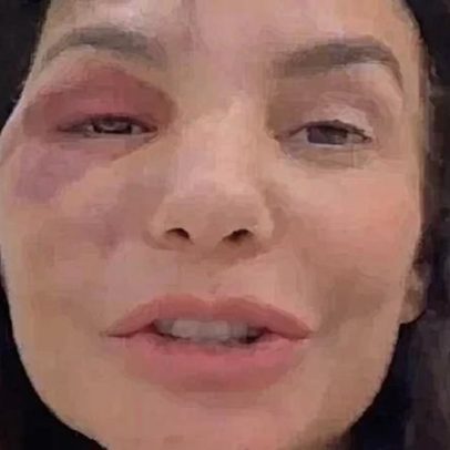 Ivete Sangalo aparece com olho roxo no BBB 26; participa de festa