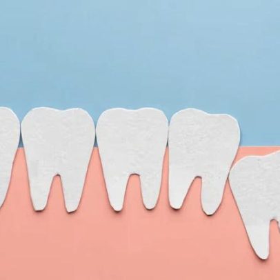 Dente do siso: por que algumas pessoas não o têm