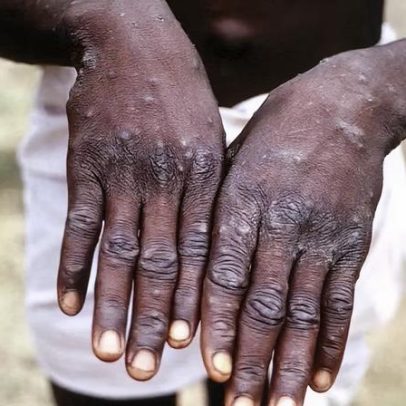 Mpox se espalha principalmente por contato sexual, diz infectologista