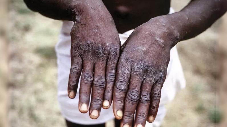 Uma pessoa negra mostra as mãos esticadas cheias de caroços e usa um short branco. O fundo da imagem está desfocado.