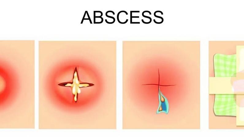 Cisto e abscesso: quando ignorar a ferida pode ser perigoso