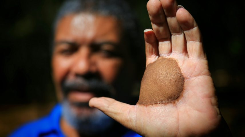 Muitos dos sobreviventes do acidente ficaram com lesões na pele devido à contaminação