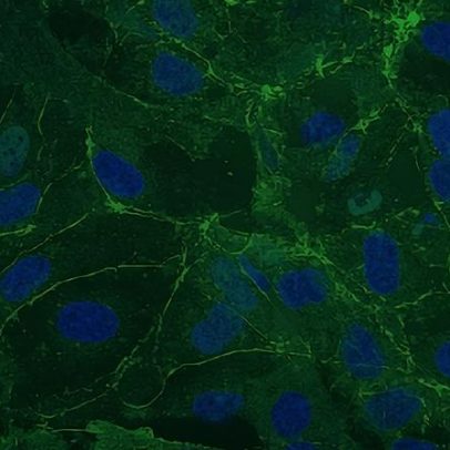 Genética revela causa de vasos cerebrais permeáveis na síndrome de Rett