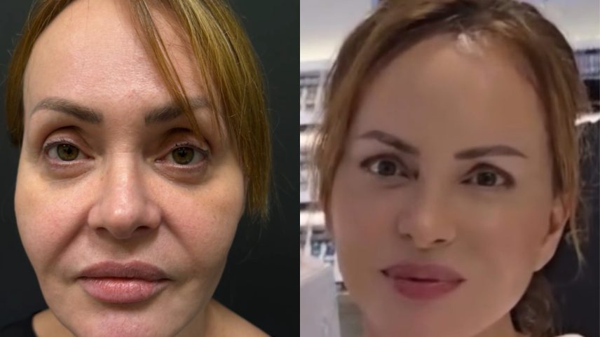 Gabriela Spanic mostrou resultado de procedimentos estéticos no rosto