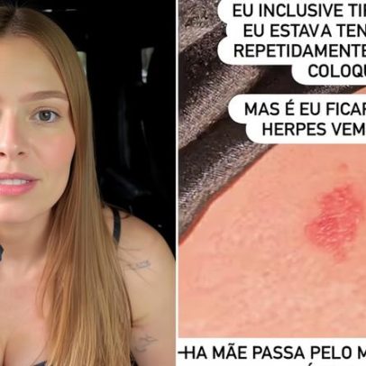 Viih Tube afirma ter removido DIU após herpes recorrentes