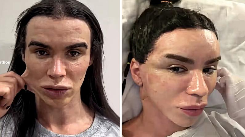 Rafa Uccman antes da cirurgia plástica e no pós-operatório