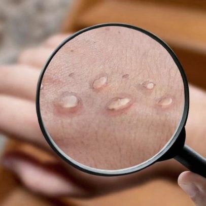 Casos de mpox em Minas sobem para 17