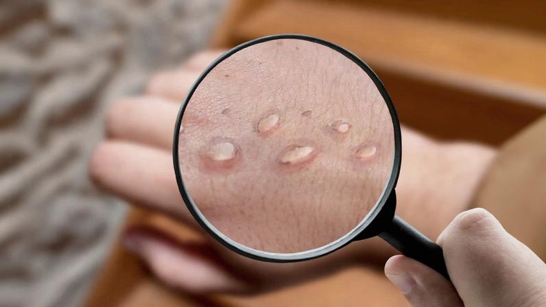 A mpox existe há décadas em países da África, principalmente na República Democrática do Congo