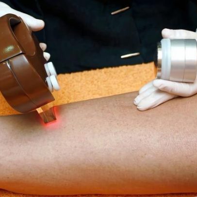 Cliente indenizada após queimaduras em depilação a laser na região íntima em BH