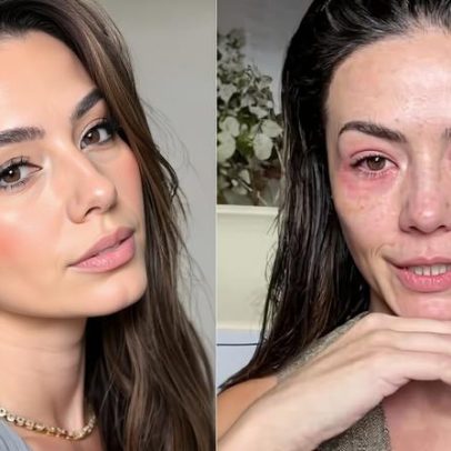 Influenciadora de beleza relata crise de alergia facial