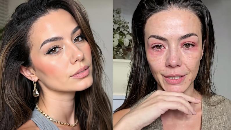 Influenciadora de beleza relata crise de alergia facial