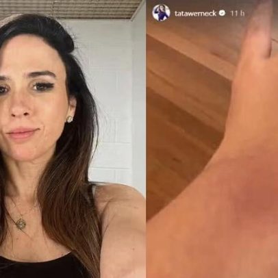 Tata Werneck surge com as mãos machucadas após anestesia