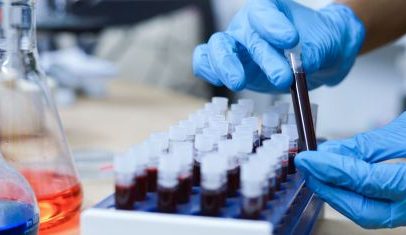 Exame de sangue em teste no Brasil pode detectar câncer de mama