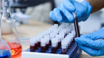 Teste desenvolvido pela Faculdade de Medicina do ABC apresentou precisão de 95% na identificação da doença em estágios iniciais