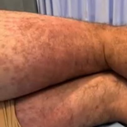 Dermatologista explica reação de Lucas Malvacini após ataque de percevejos