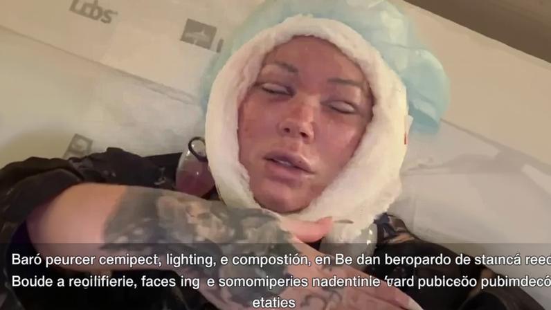 Esposa de 46 anos de Jelly Roll revela consequências do lifting facial