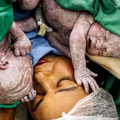Influenciadora Bruna Lohaine dá à luz gêmeos após sobreviver a parada cardíaca