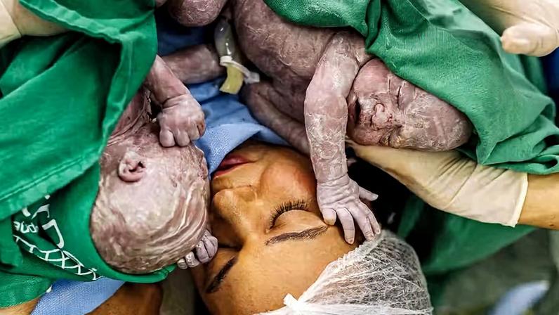 Influenciadora Bruna Lohaine dá à luz gêmeos após sobreviver a parada cardíaca