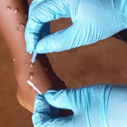 MG registra 2 novos casos de mpox e total chega a 17