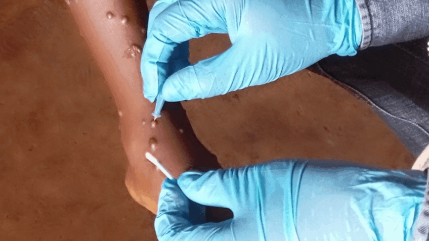 Lesões na pele são um dos sintomas característicos da Mpox