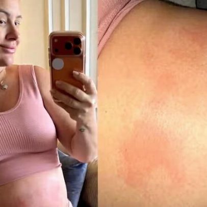 Patrícia Leitte mostra manchas na barriga e levanta hipótese de urticária gravídica