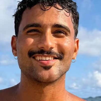 Ex-BBB Lucas Pizane revela resultado da compensação para assimetria facial