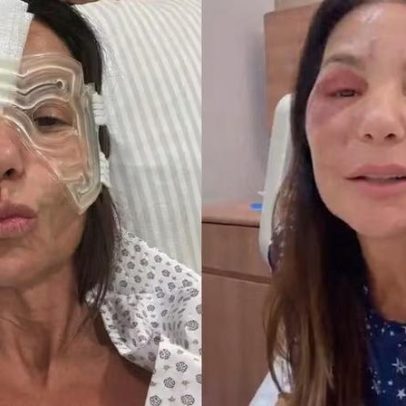 Ivete Sangalo aparece com cabeça de gelo e confirma recuperação após cirurgia