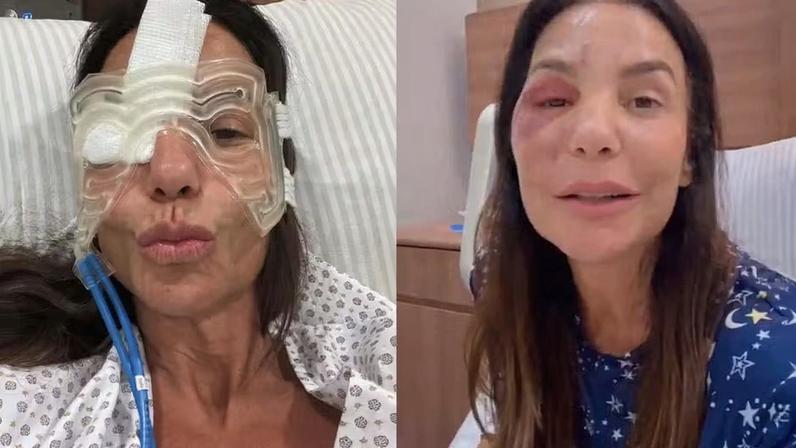 Ivete mostra recuperação após cirurgia no rosto — Foto: Reprodução/ Instagram