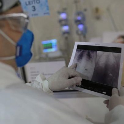 Broncopneumonia causa internação de Bolsonaro e explica quadro clínico