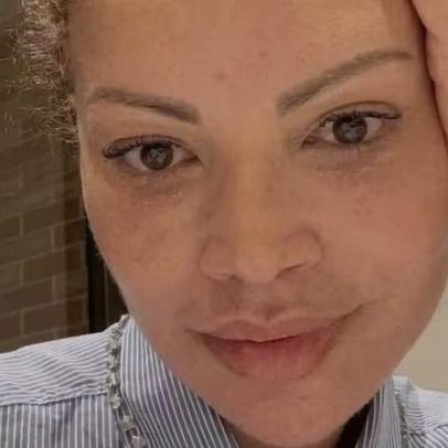 Solange Almeida mostra rosto após procedimento estético