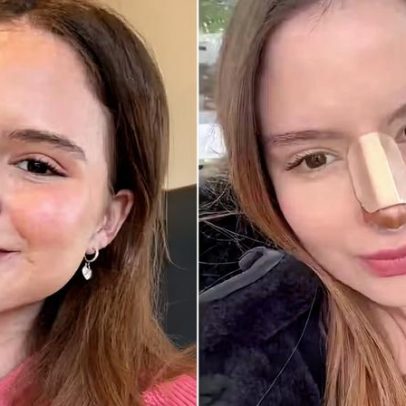 Sophia Valverde mostra resultado de cirurgia no nariz