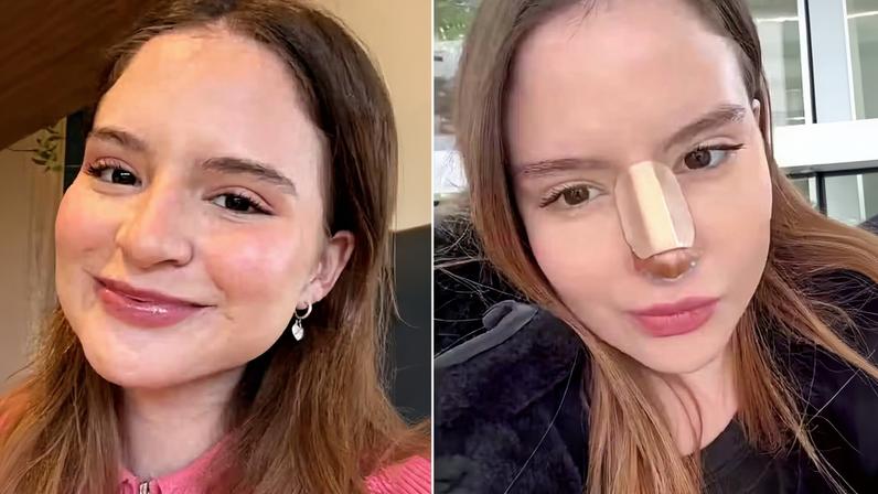 Sophia Valverde mostra resultado de cirurgia no nariz