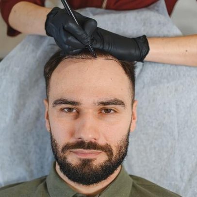 Quando é necessário refazer um transplante capilar