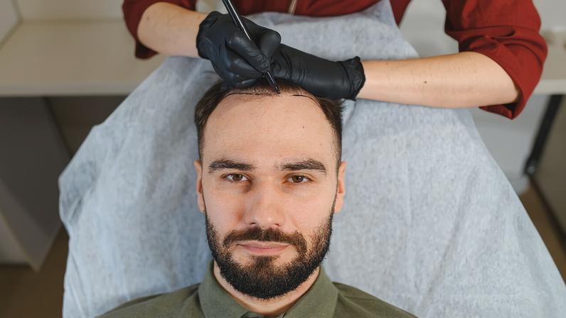 A recomendação de um novo transplante capilar varia conforme as especificidades do paciente