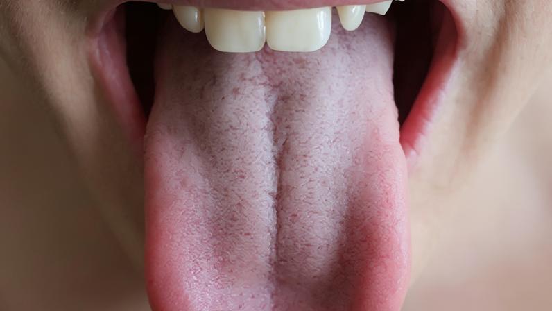 Língua esbranquiçada: causas, cuidados e quando procurar atendimento médico