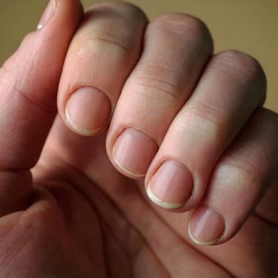 Manchas brancas nas unhas: a leuconíquia pontuada não indica carências
