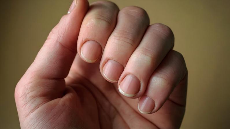 Manchinhas brancas nas unhas? Na maioria das vezes, não é falta de cálcio -depositphotos.com / natali_ploskaya
