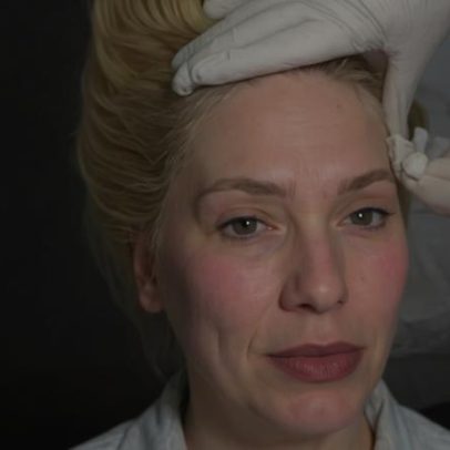 Virginia Fonseca mostra acne severa e tratamento para evitar marcas
