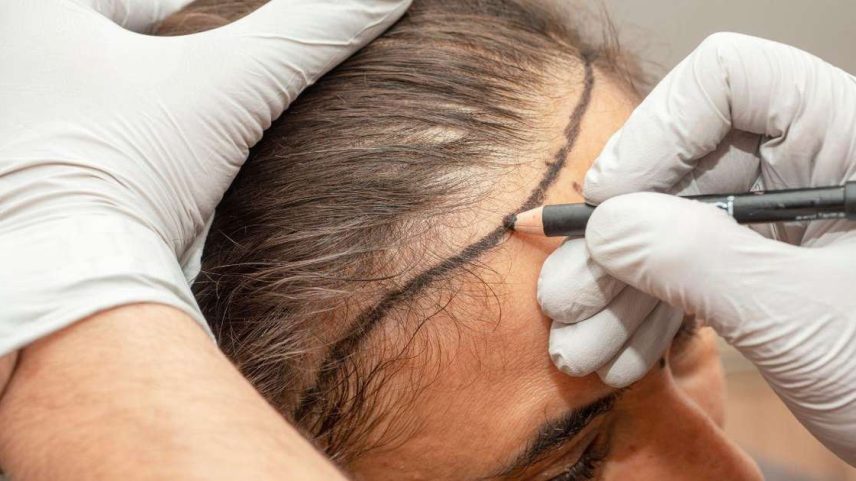 Veja quando é seguro voltar para os treinos após transplante capilar