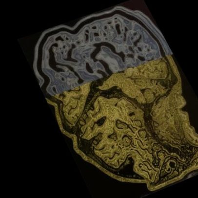 Revisão de estudos aponta baixa eficácia de fármacos contra Alzheimer