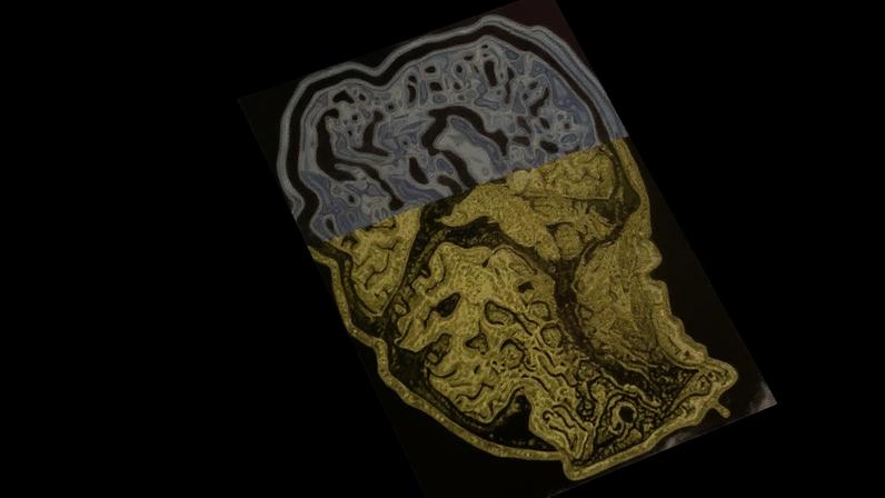 Montagem de um exame cerebral mostrando demência/Alzheimer em estágio inicial.
