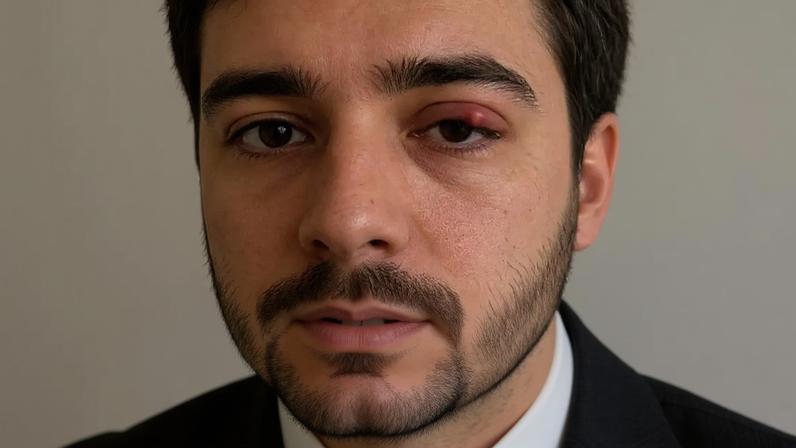 Olhar para o sol e terçol: desvendando o mito e os reais fatores