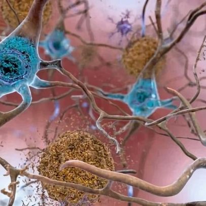 Revisão aponta que tratamentos para Alzheimer não funcionam